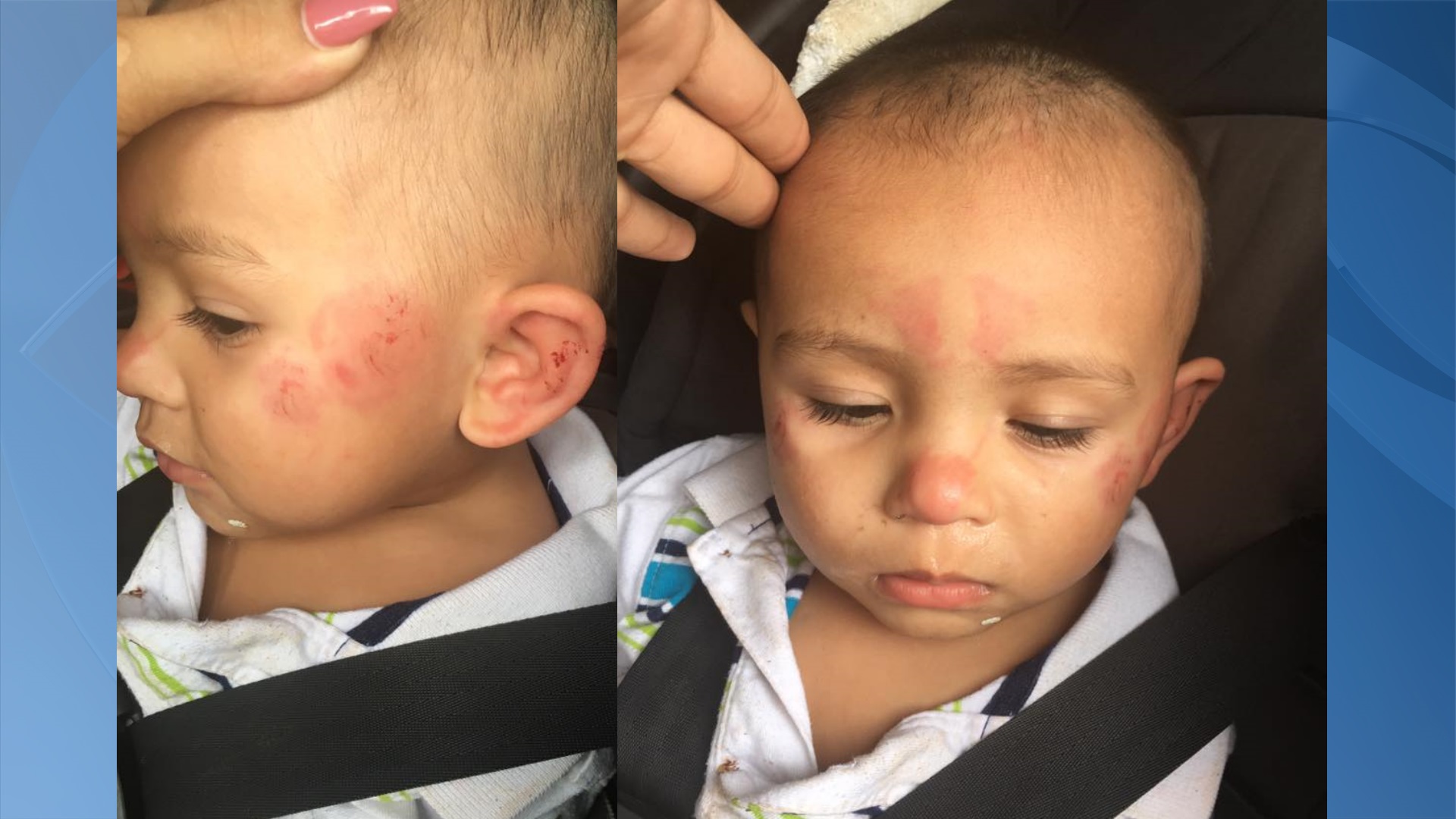 toddler-bitten-more-than-a-dozen-times-at-day-care