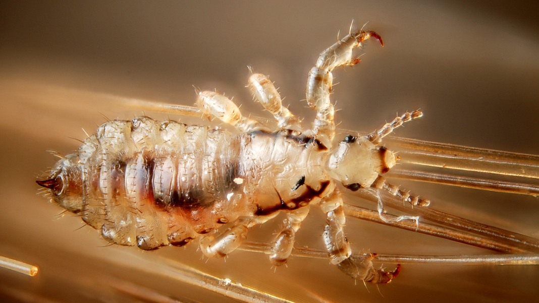 Lice advice: How to kill the pesky, irritating bugs