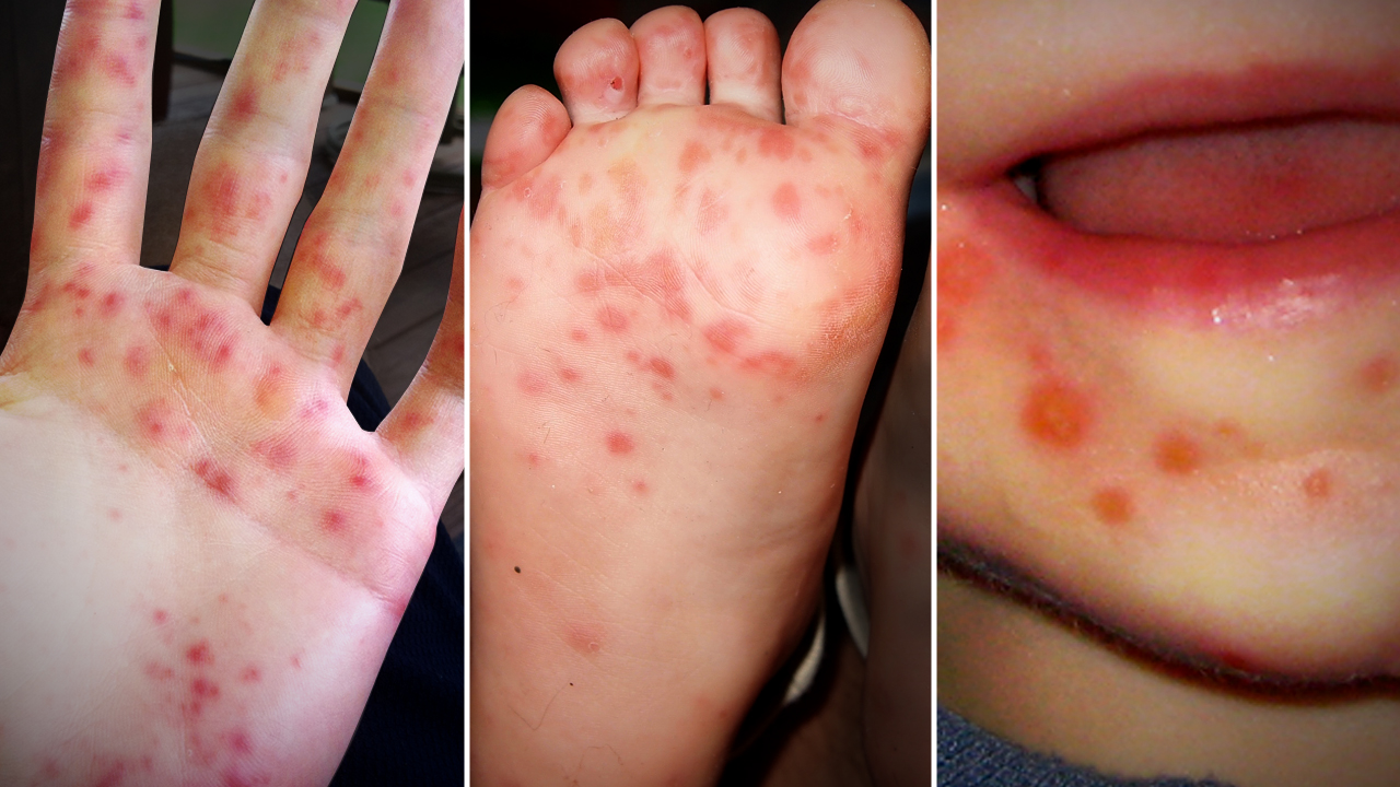 Doctors See Increase In Hand Foot And Mouth Disease WINK News   1280x720 80808B00 JFXYS 