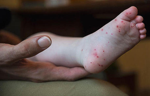 hand-foot-and-mouth-disease-cases-flare-up-in-several-states