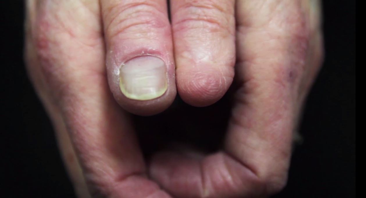 White Line On Nail Cancer