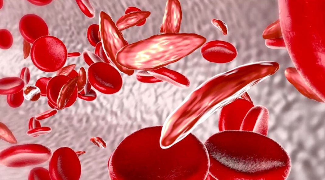 New drug could help those fighting sickle cell disease