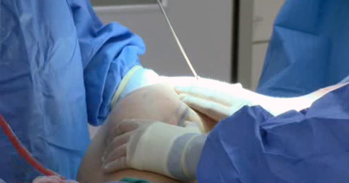 Seven plastic surgeons are asking an appeals court to block a new state emergency rule that placed additional restrictions on the procedure known as the Brazilian butt lift.