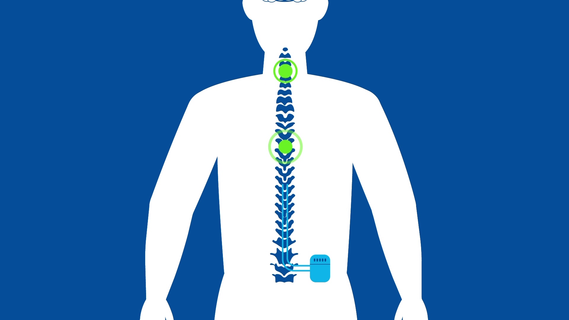 spinal-stimulator-stops-diabetic-nerve-pain