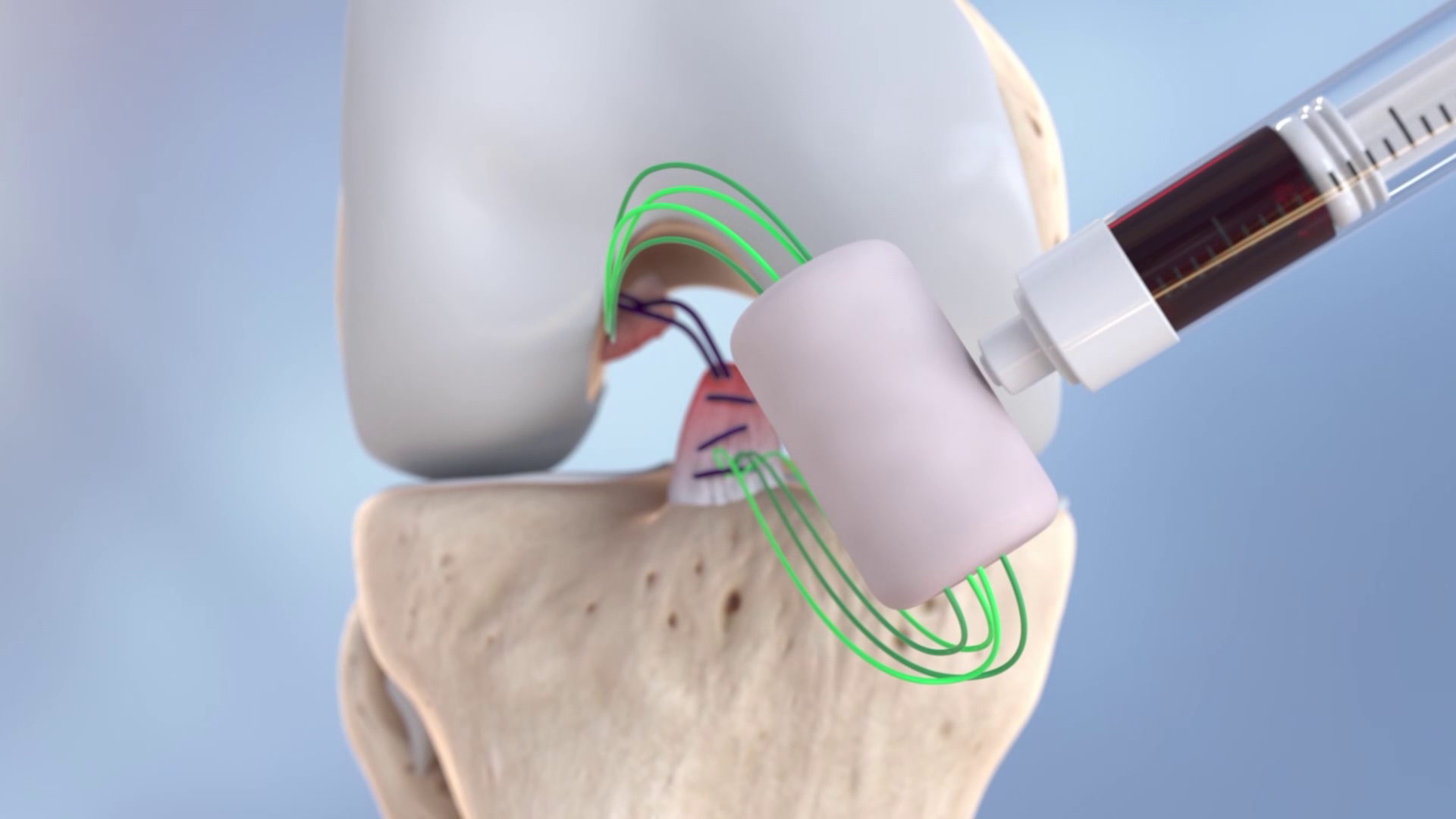 less-invasive-treatment-option-helping-acl-surgery-recovery-time-wink